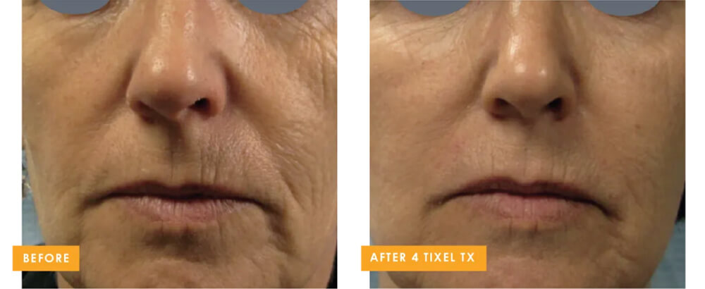 Before (Left) After (Right)