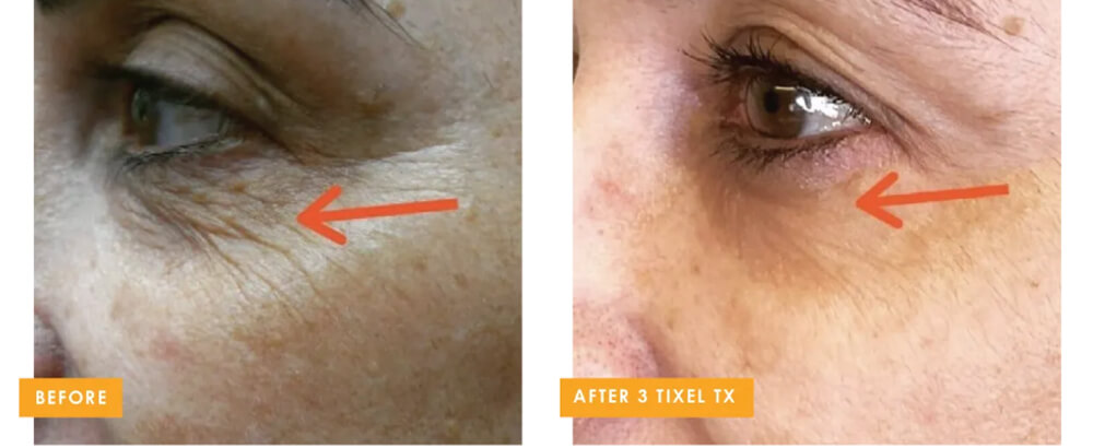 Before (Left) After (Right)