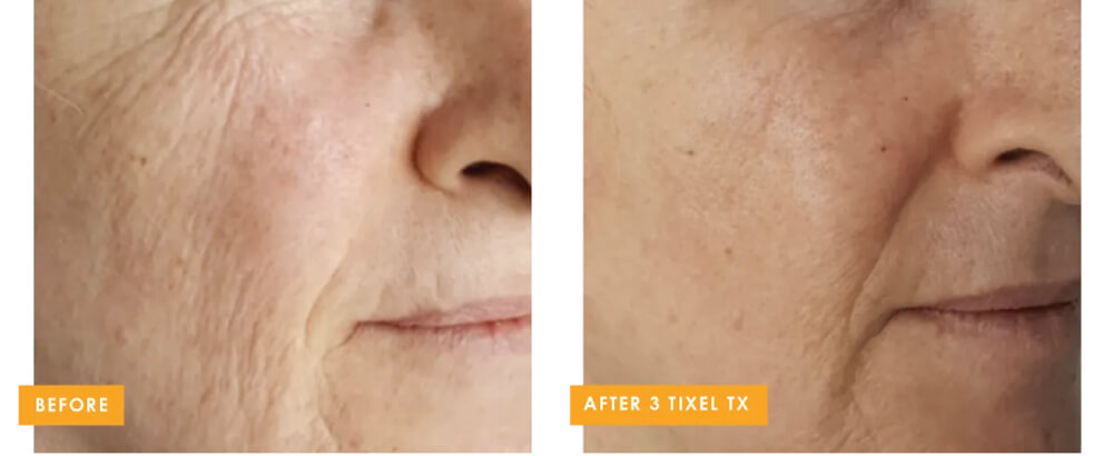 Before (Left) After (Right)