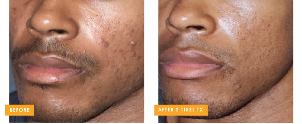 Before (Left) After (Right)