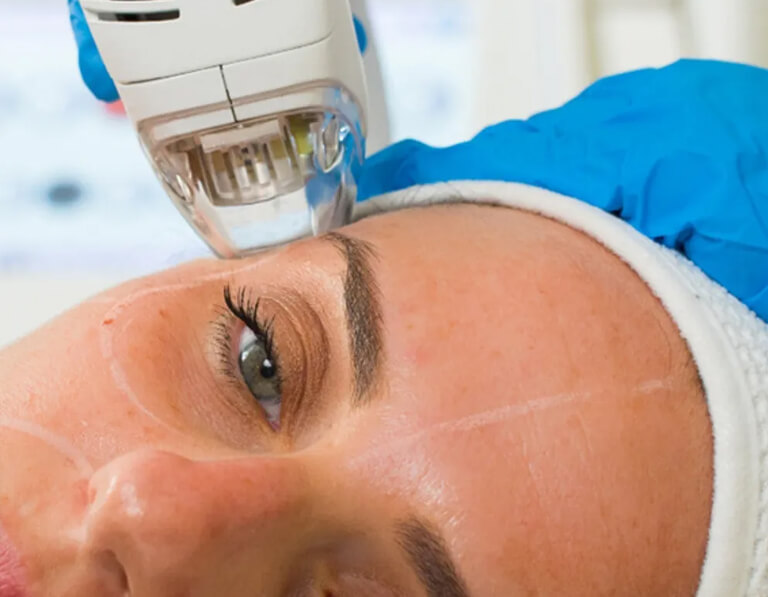 A patient having a Tixel treatment